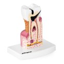 Model anatomiczny chorego zęba człowieka w skali 6:1